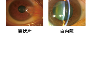 眼病×紫外線